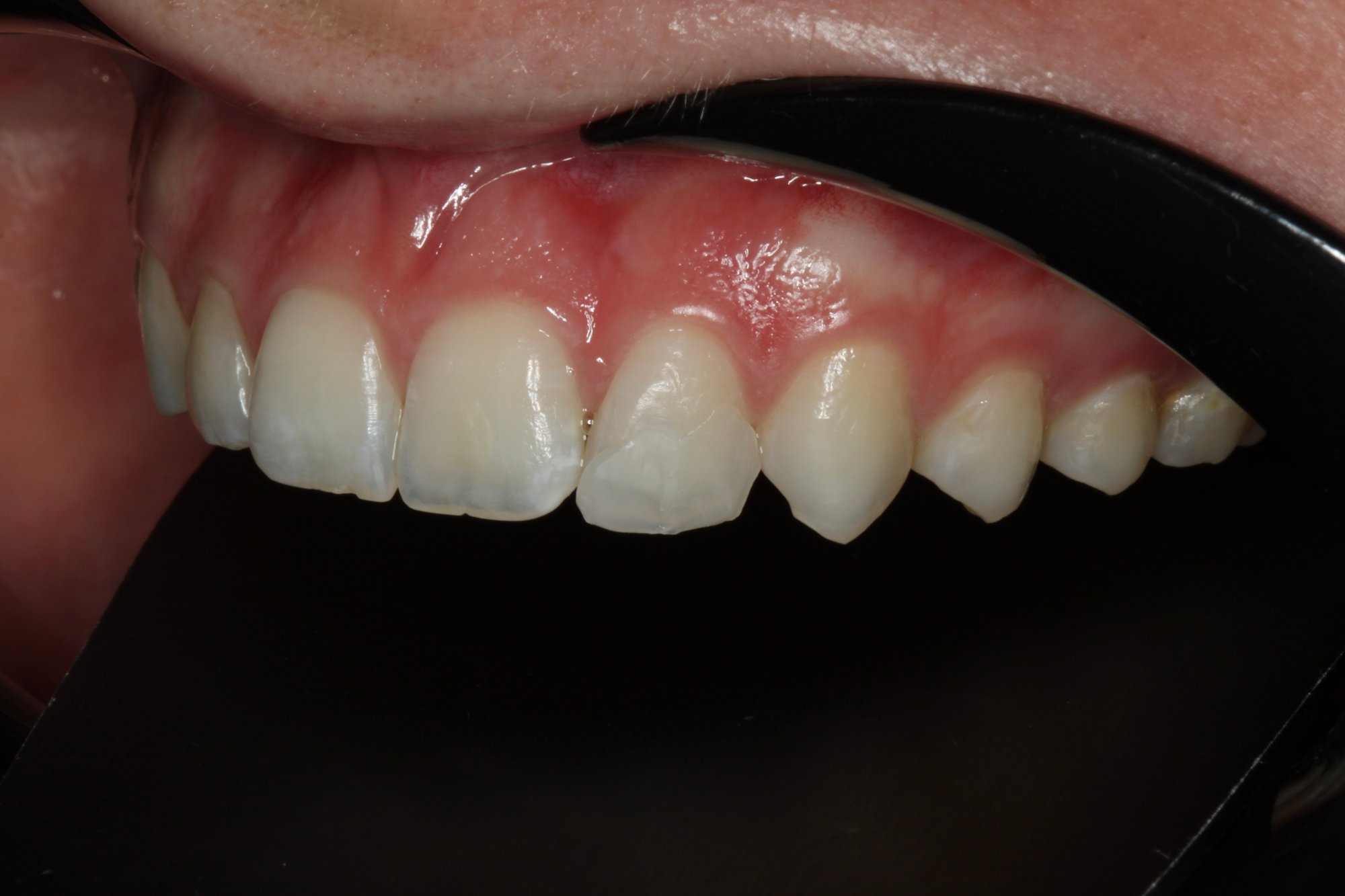 Aufnahme der Zähne Aufnahme der Zähne