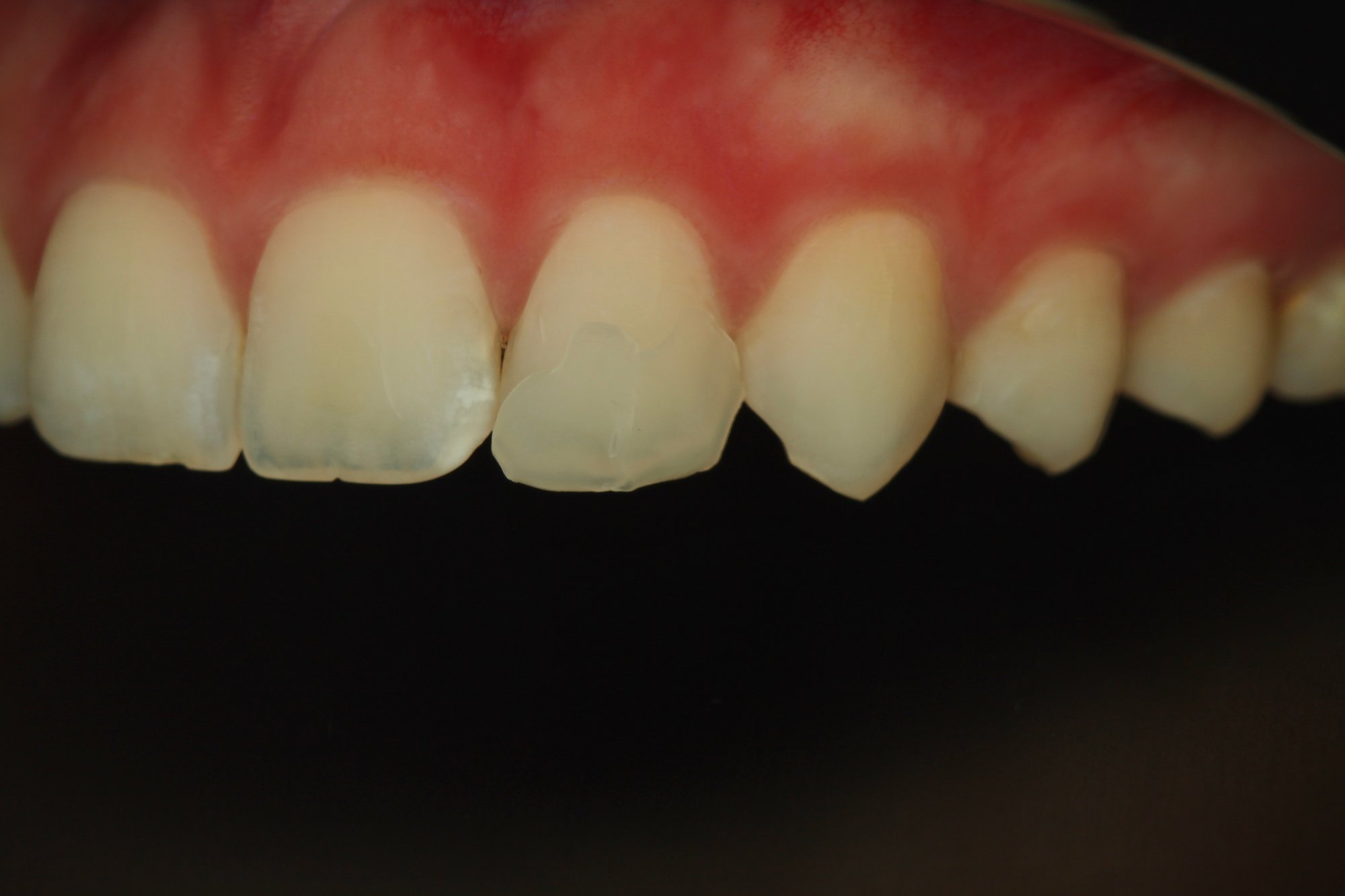 Aufnahme der Zähne Aufnahme der Zähne