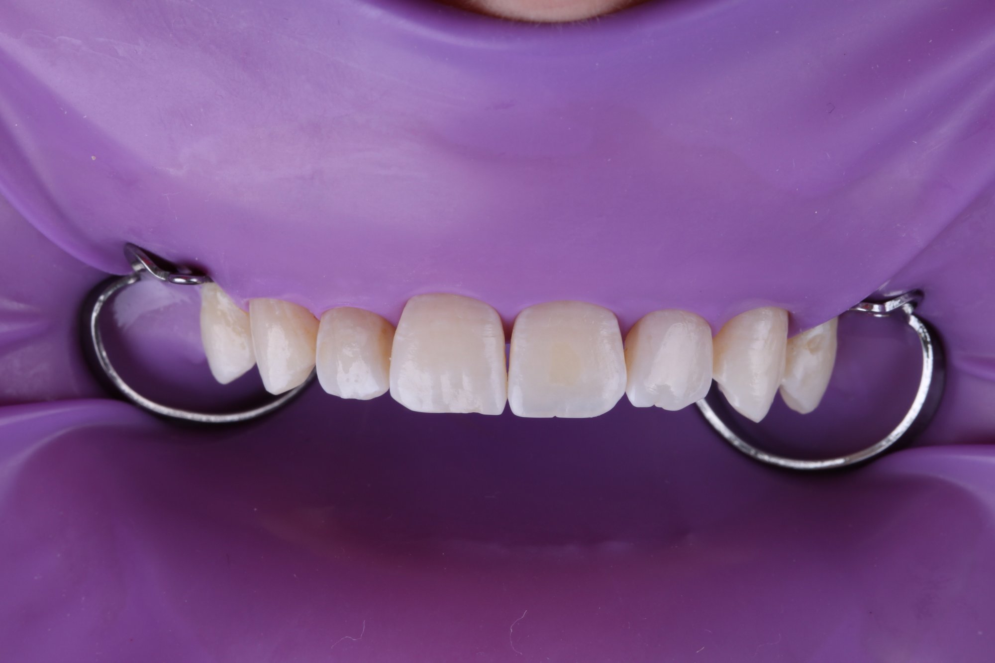 Isolierung der Zähne mit Kofferdam Isolierung der Zähne mit Kofferdam