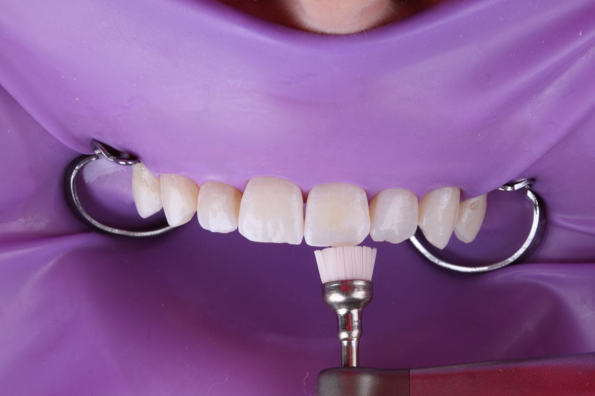 Biofilm wird mit Bimssteinpaste und Prophylaxebürste entfernt Biofilm wird mit Bimssteinpaste und Prophylaxebürste entfernt