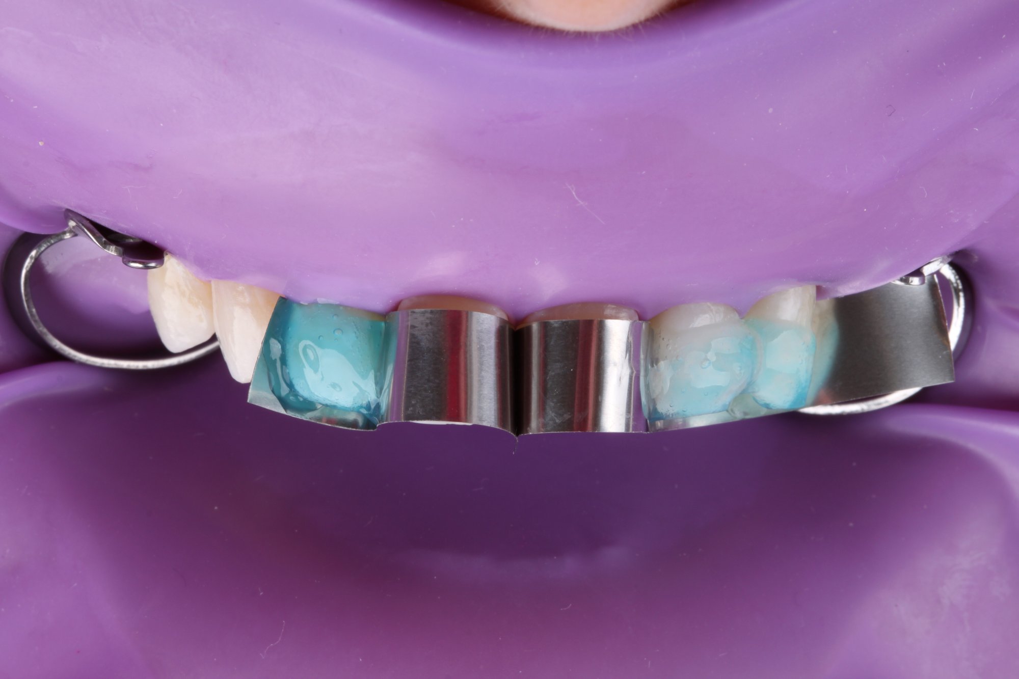 Ätzen der Zähne mit Phosphorsäure-Gel Ätzen der Zähne mit Phosphorsäure-Gel