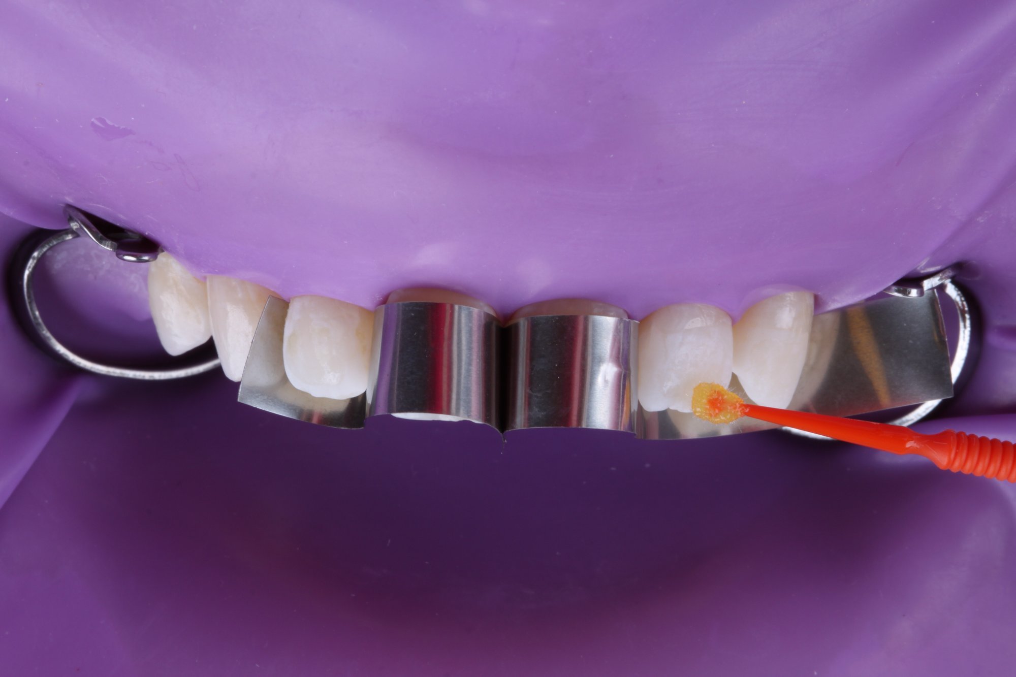 Anwendung von 3M™ Scotchbond™ Universal Plus Adhäsiv auf den Zähnen Anwendung von 3M™ Scotchbond™ Universal Plus Adhäsiv auf den Zähnen