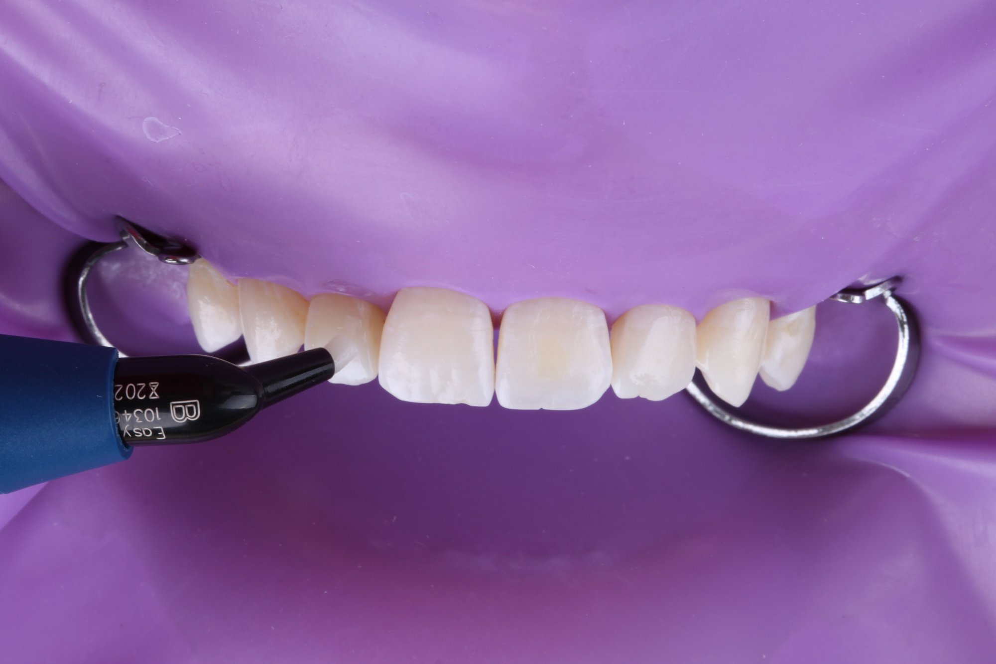 Applikation von 3M™ Filtek™ Easy Match, Farbton Bright auf den Zähnen Applikation von 3M™ Filtek™ Easy Match, Farbton Bright auf den Zähnen