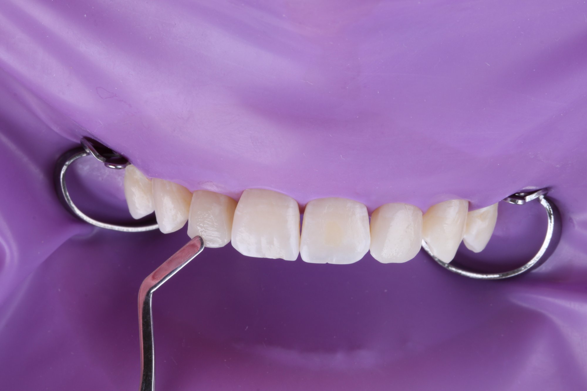 Anatomische Modellation des Zahns 12 mit einem Spatel Anatomische Modellation des Zahns 12 mit einem Spatel