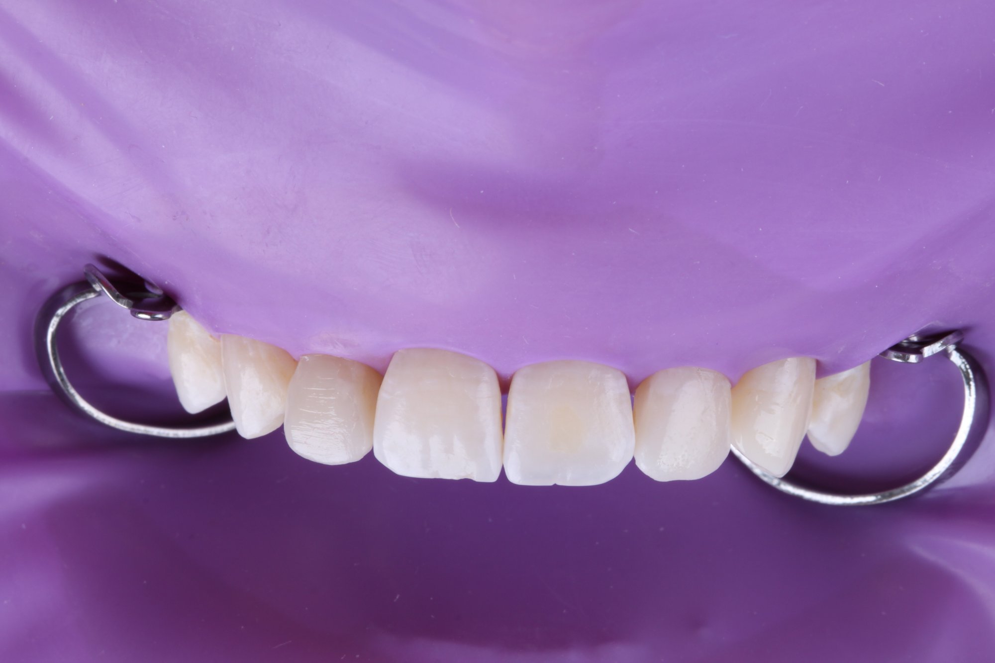 Ausgearbeitete Restaurationen der Zähne vor der Politur. Ausgearbeitete Restaurationen der Zähne vor der Politur.