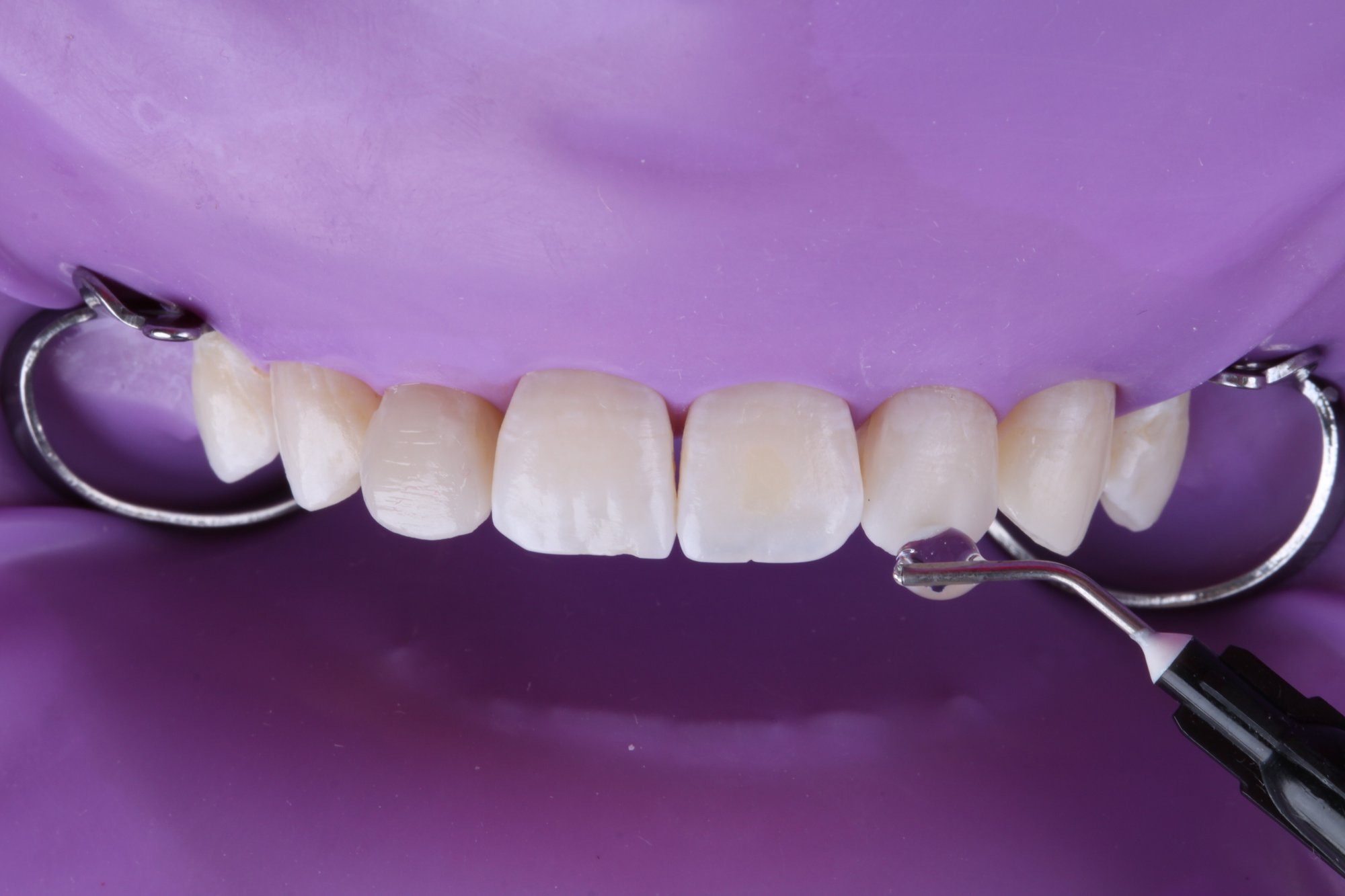 Glyceringel vor Lichthärtung auf den Zähnen aufgetragen Glyceringel vor Lichthärtung auf den Zähnen aufgetragen