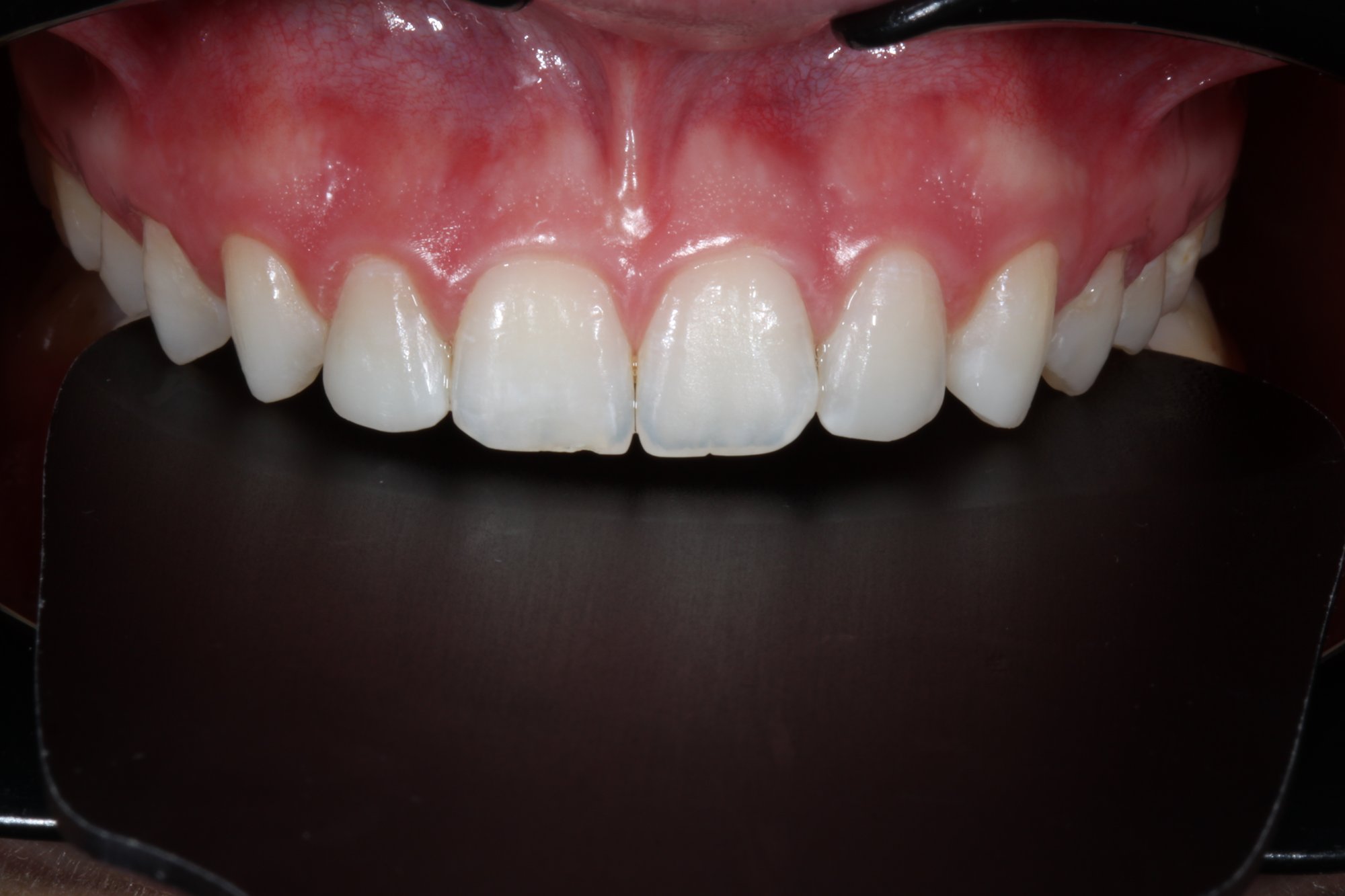 Zähne nach Ausarbeitung und Politur mit 3M™ Sof-Lex™ Scheiben und Rädern Zähne nach Ausarbeitung und Politur mit 3M™ Sof-Lex™ Scheiben und Rädern