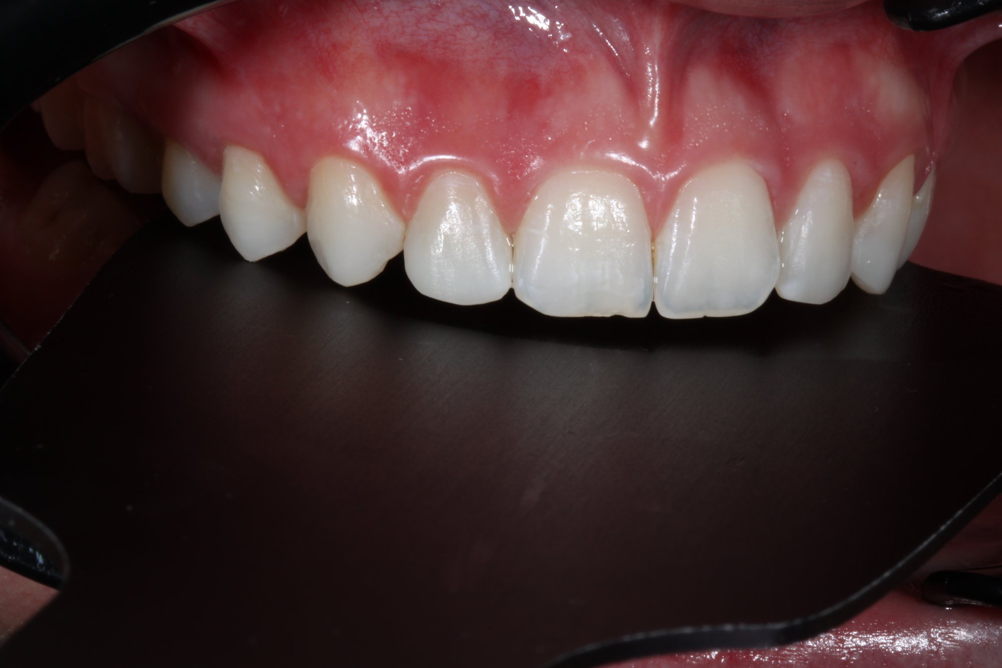 Definitive Restaurationen der Zähne: Ansicht von lateral. Definitive Restaurationen der Zähne: Ansicht von lateral.