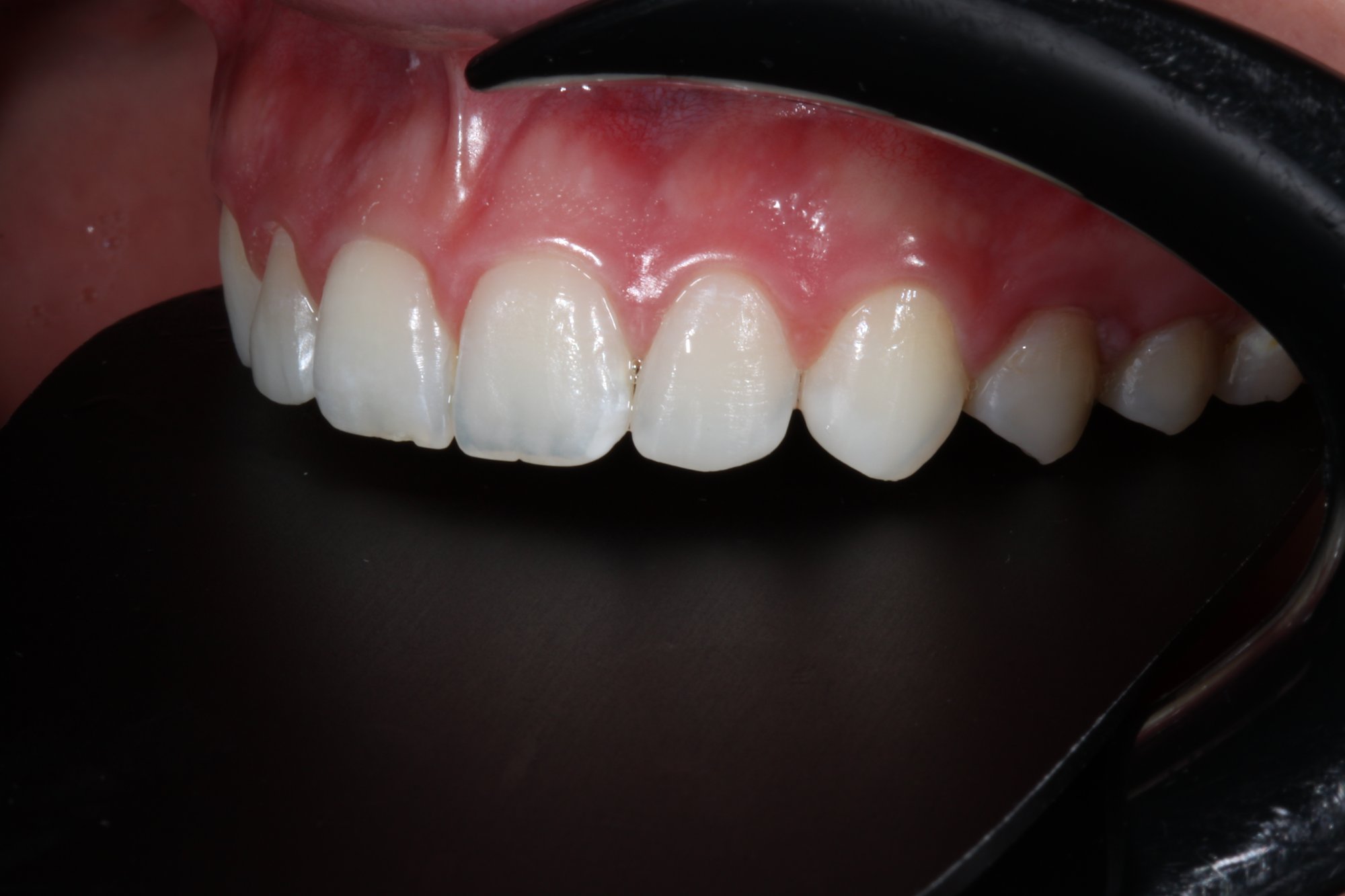 Definitive Restaurationen der Zähne: Ansicht von lateral. Definitive Restaurationen der Zähne: Ansicht von lateral.