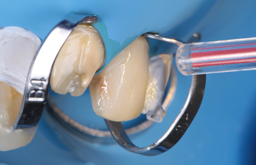 Lufttrocknen von 3M™ Scotchbond™ Universal Plus Adhäsiv. 