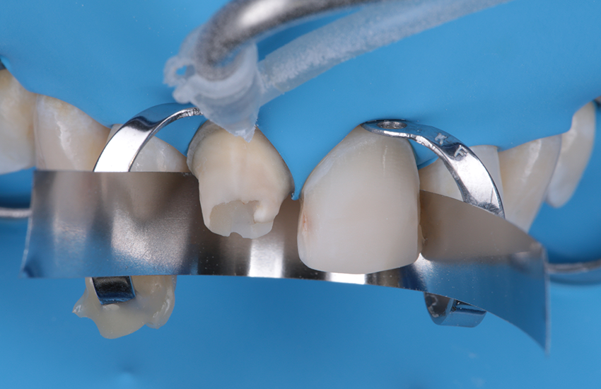 Kompositaufbau mit 30 µm Aluminiumoxid sandgestrahlt.