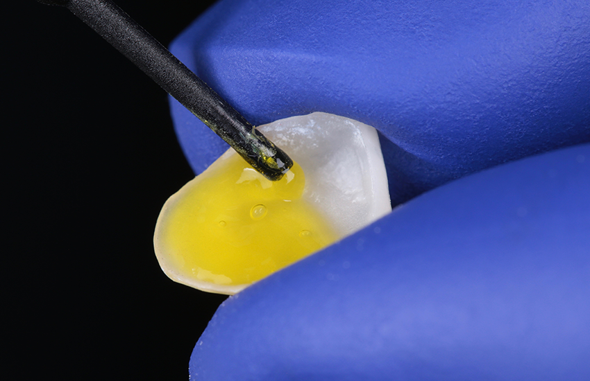 Vorbehandlung eines Glaskeramik-Veneers mit Flusssäure