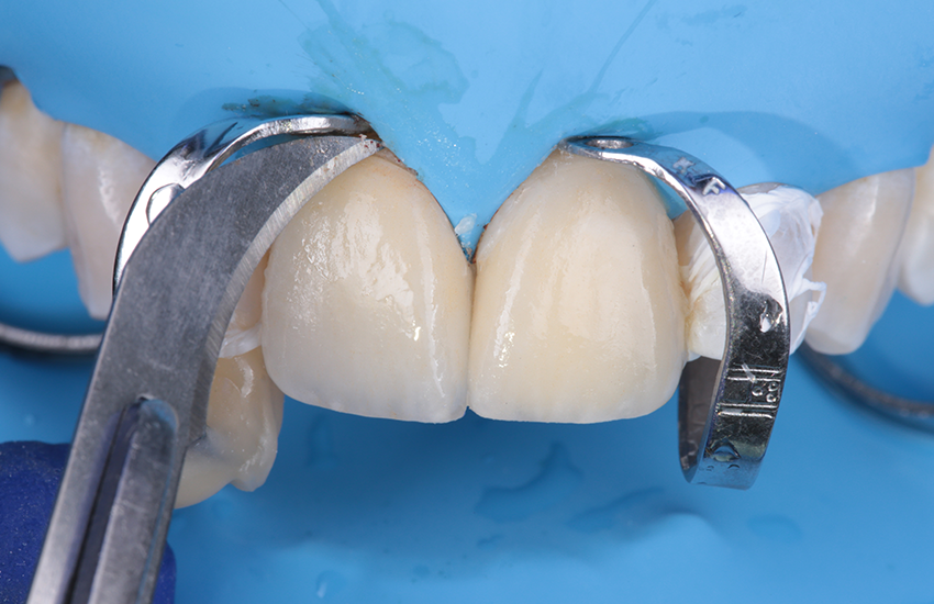 Überschüssiges Befestigungskomposit endgültig mit Klinge entfernt.