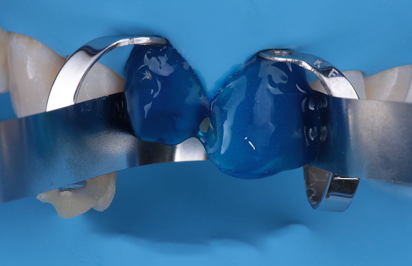 Ätzen der Präparationen mit Phosphorsäure 