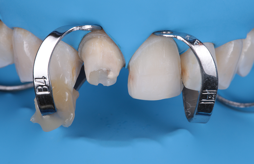 Präparationen isoliert mit Kofferdam&nbsp;