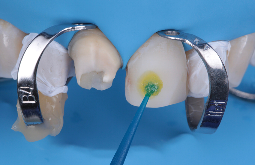 Auftragen von 3M™ Scotchbond™ Universal Plus Adhäsiv. 