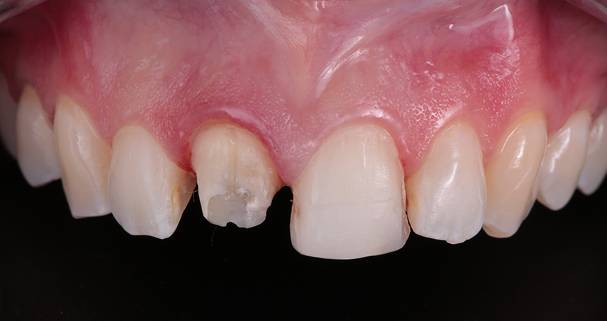 Veneer- und Kronenpräparationen an Zähnen 11 und 12 für Einprobe vorbereitet