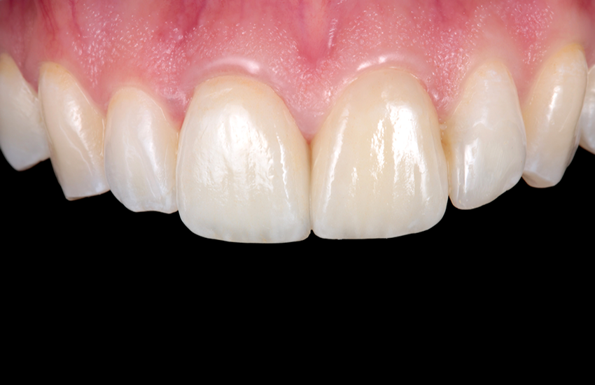 Ergebnis zwei Monate nach Behandlungsabschluss. 