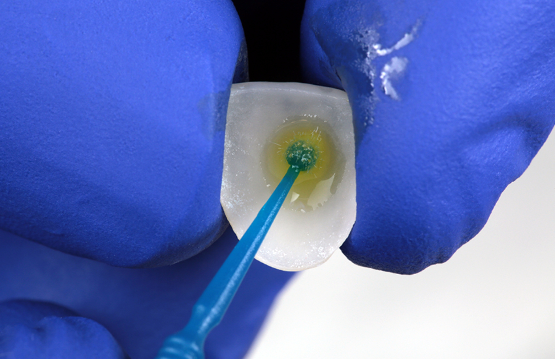 3M™ Scotchbond™ Universal Plus Adhäsiv als Silan auf geätztes Glaskeramik-Veneer aufgetragen.