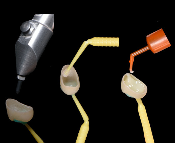 Vorbehandlung der Zahnkrone mit Komposit