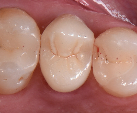 Indirekte Restauration der Zähne mit RelyX Universal Befestigungskomposit