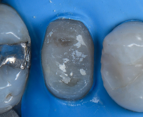 Zähne bei Trockenlegung mit Kofferdam