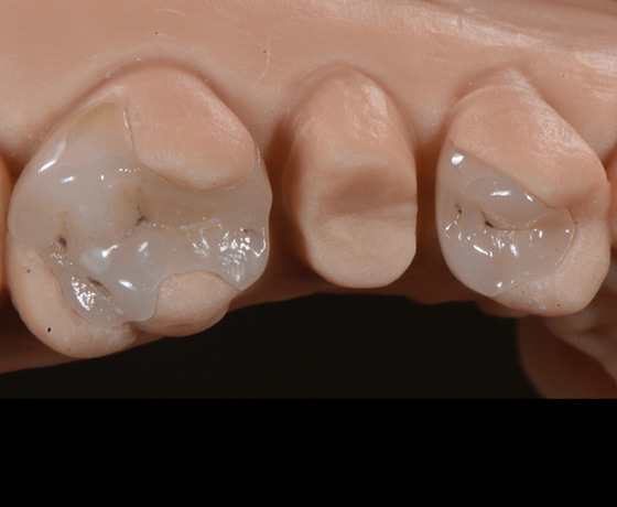 CAD/CAM-Teilrestaurationen am Zahn