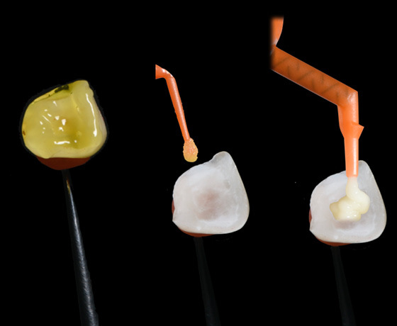 Vorbehandlung der Zahnkrone mit Flusssäure, Spülen und Auftrag von Scotchbond™ Universal Plus und RelyX™ Universal Komposit