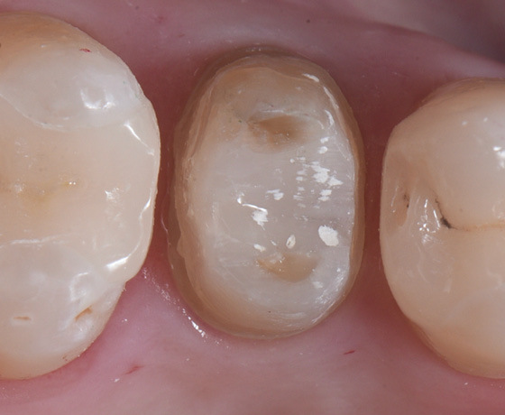 Zahn 25 mit optimaler Präparationsgrenze präpariert