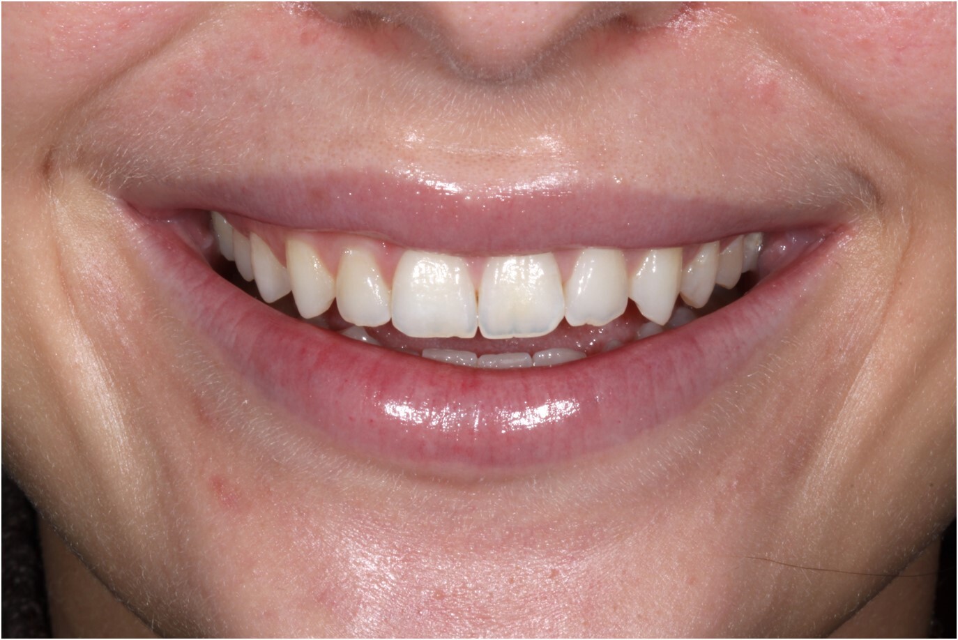 Zähne lächeln Zähne lächeln