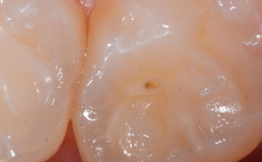 Häufig auftretende Blase in einer Fissurenversiegelung der Zähne