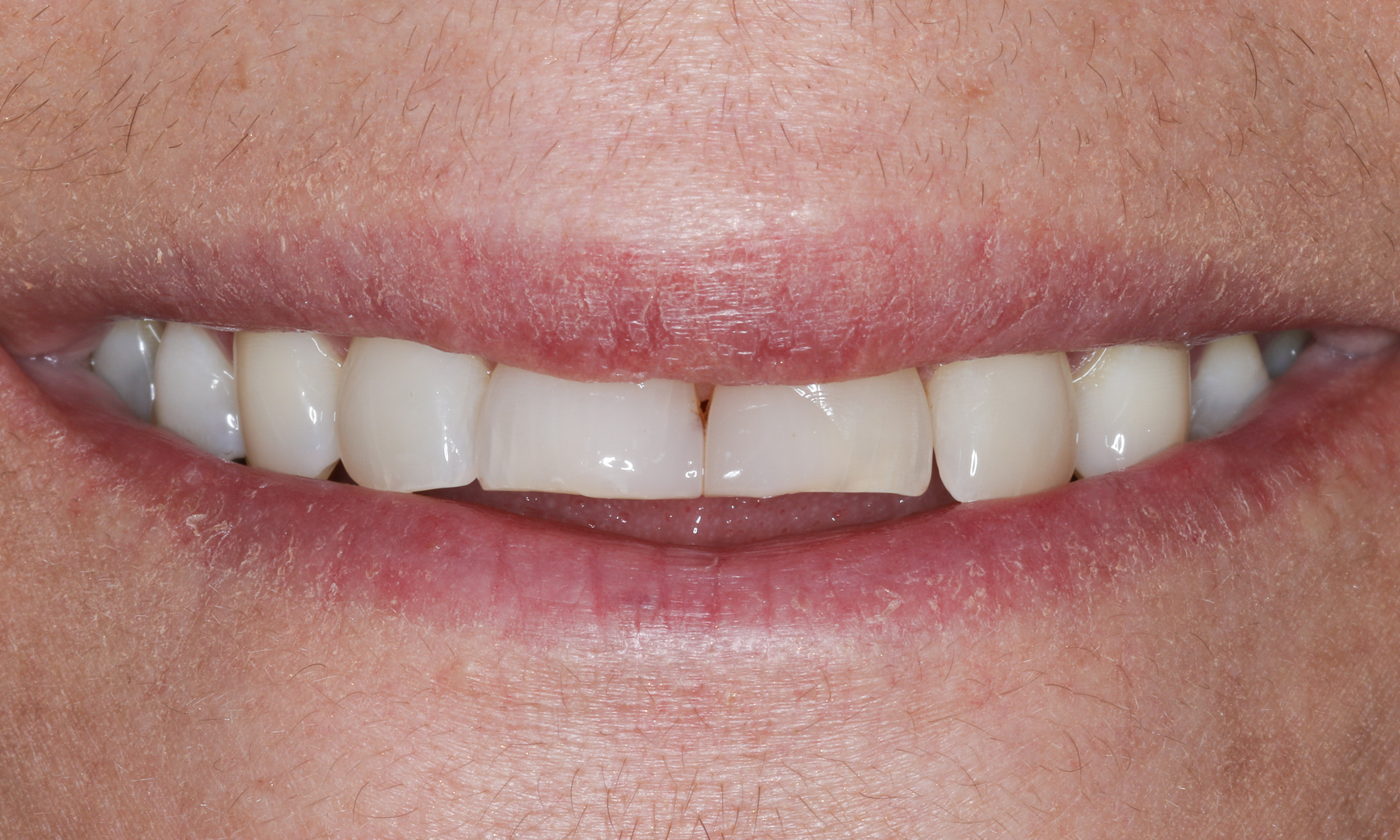 Ausgangssituation: Lächeln der Patientin Ausgangssituation: Lächeln der Patientin