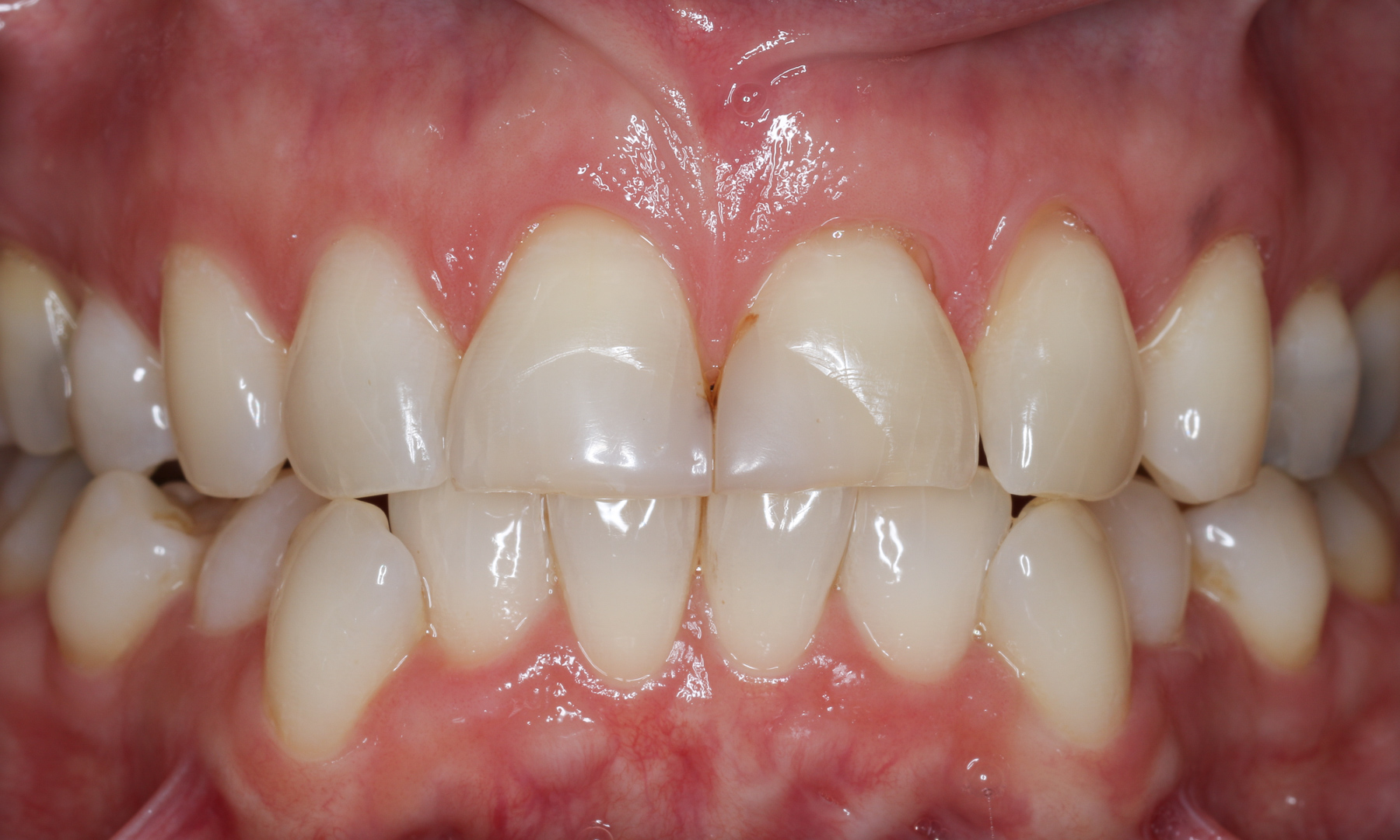 Ausgangssituation: Zähne in Okklusion Ausgangssituation: Zähne in Okklusion