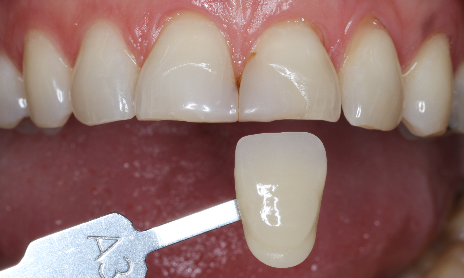 Gewählte Zahnfarbe Gewählte Zahnfarbe