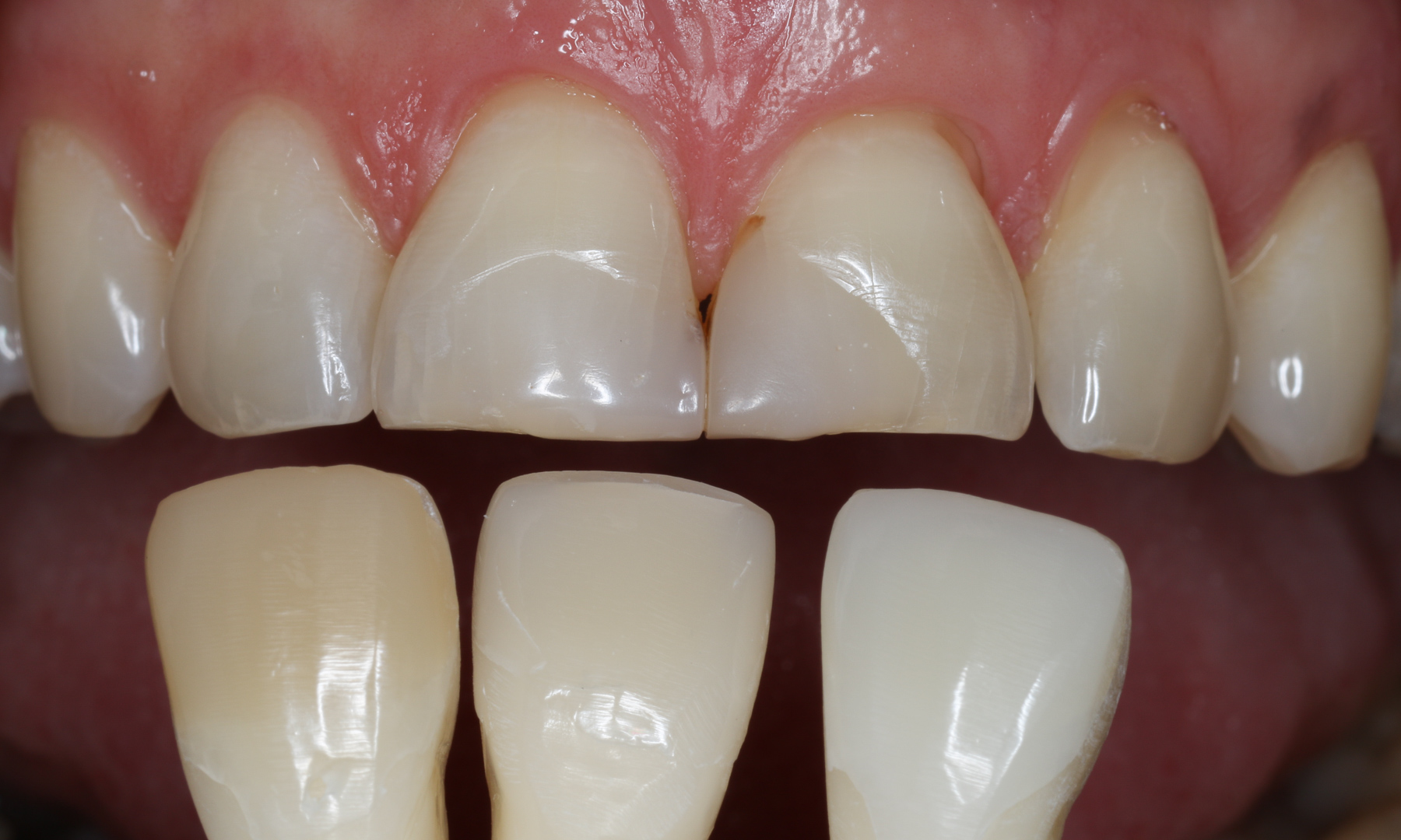 Farbauswahl der Zahnfarbe Farbauswahl der Zahnfarbe