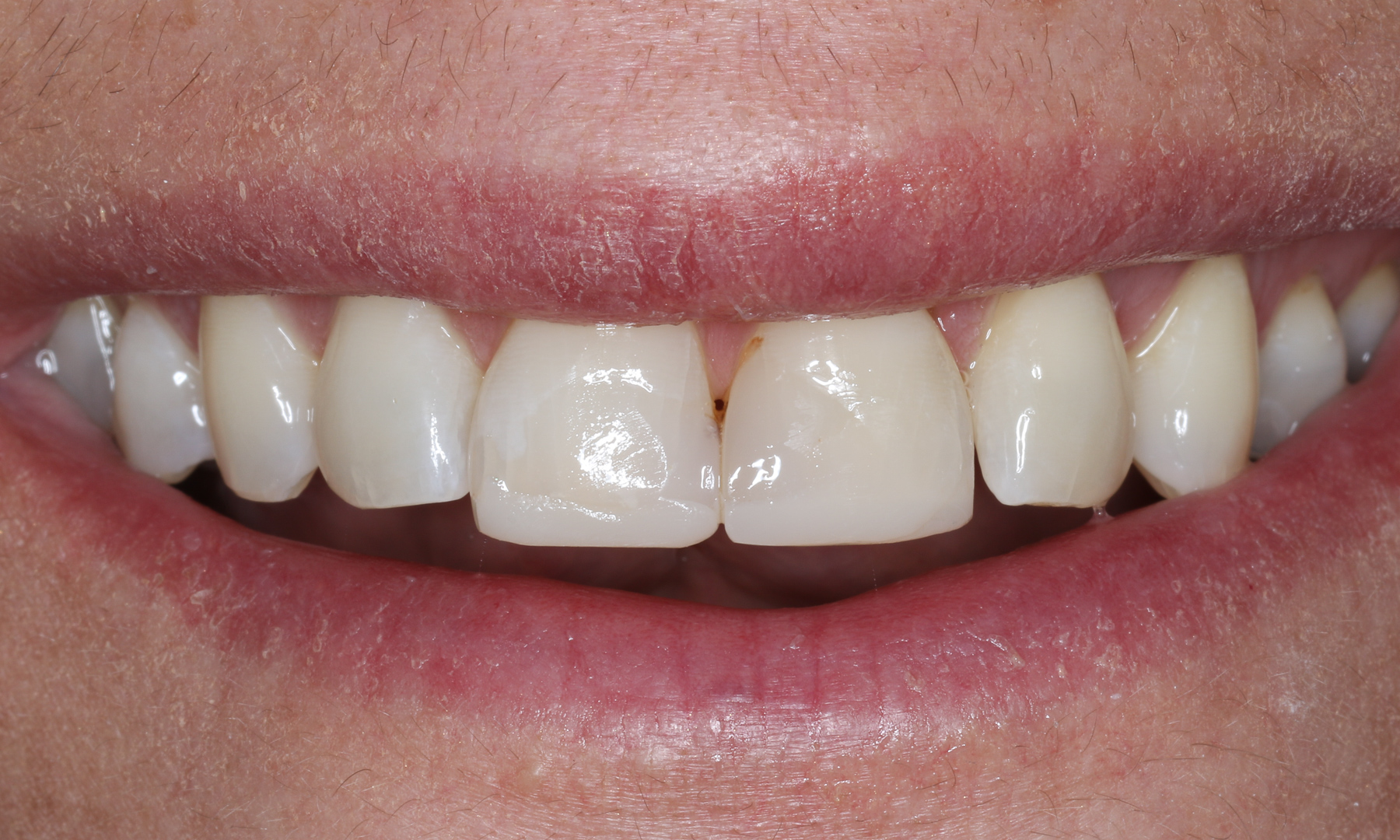 Überprüfung der gewählten Zahnfarbe Überprüfung der gewählten Zahnfarbe