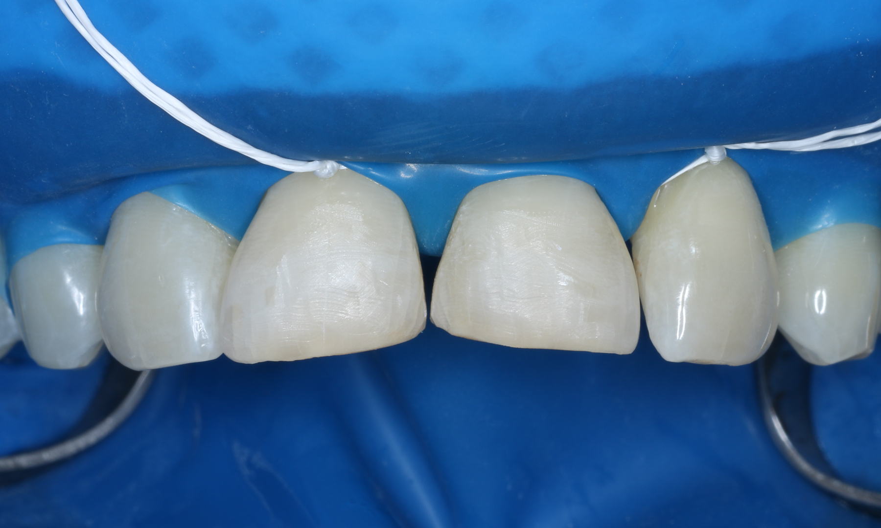 Absolute Trockenlegung der Zähne mit Kofferdam Absolute Trockenlegung der Zähne mit Kofferdam