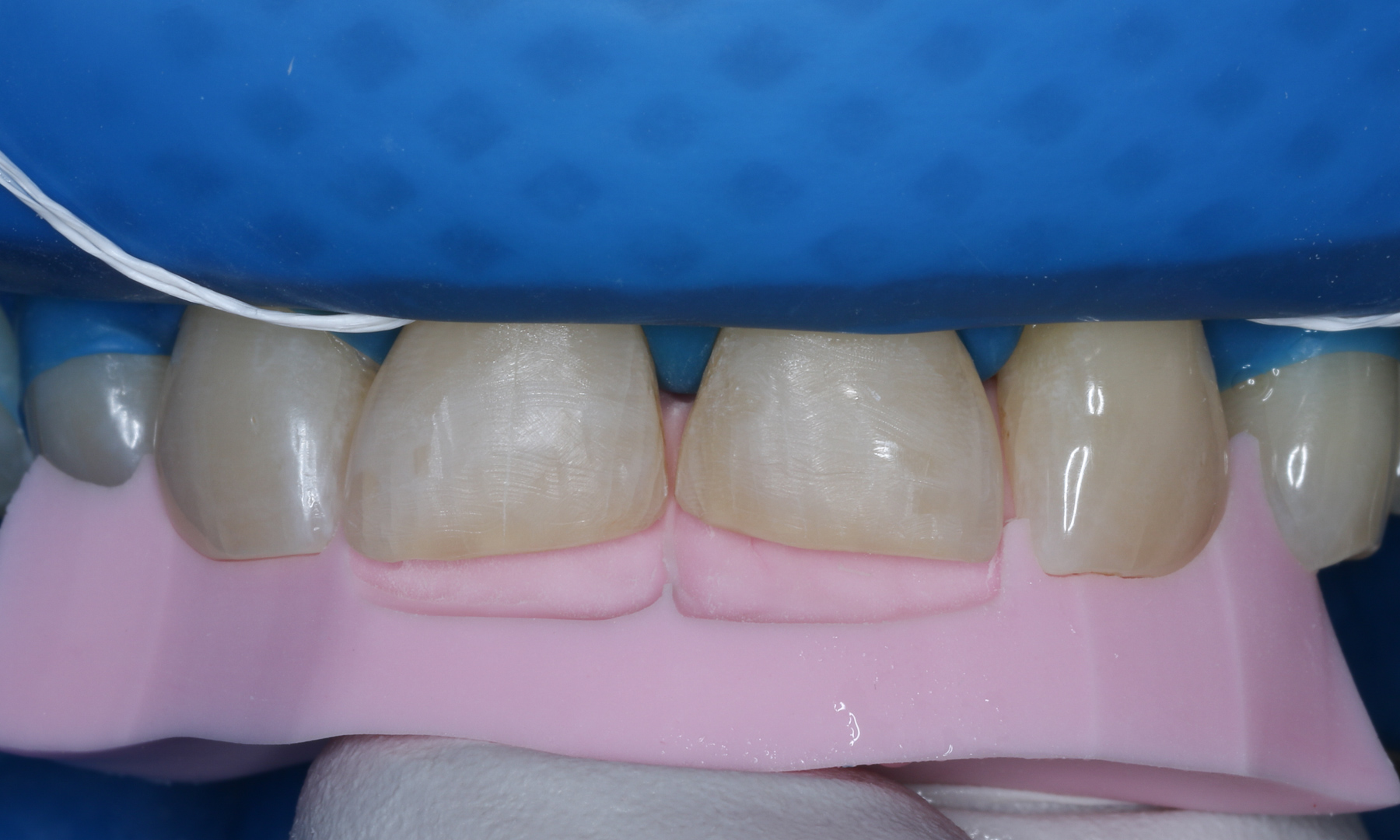 Einprobe des Silikonschlüssels zur Passungskontrolle Einprobe des Silikonschlüssels zur Passungskontrolle