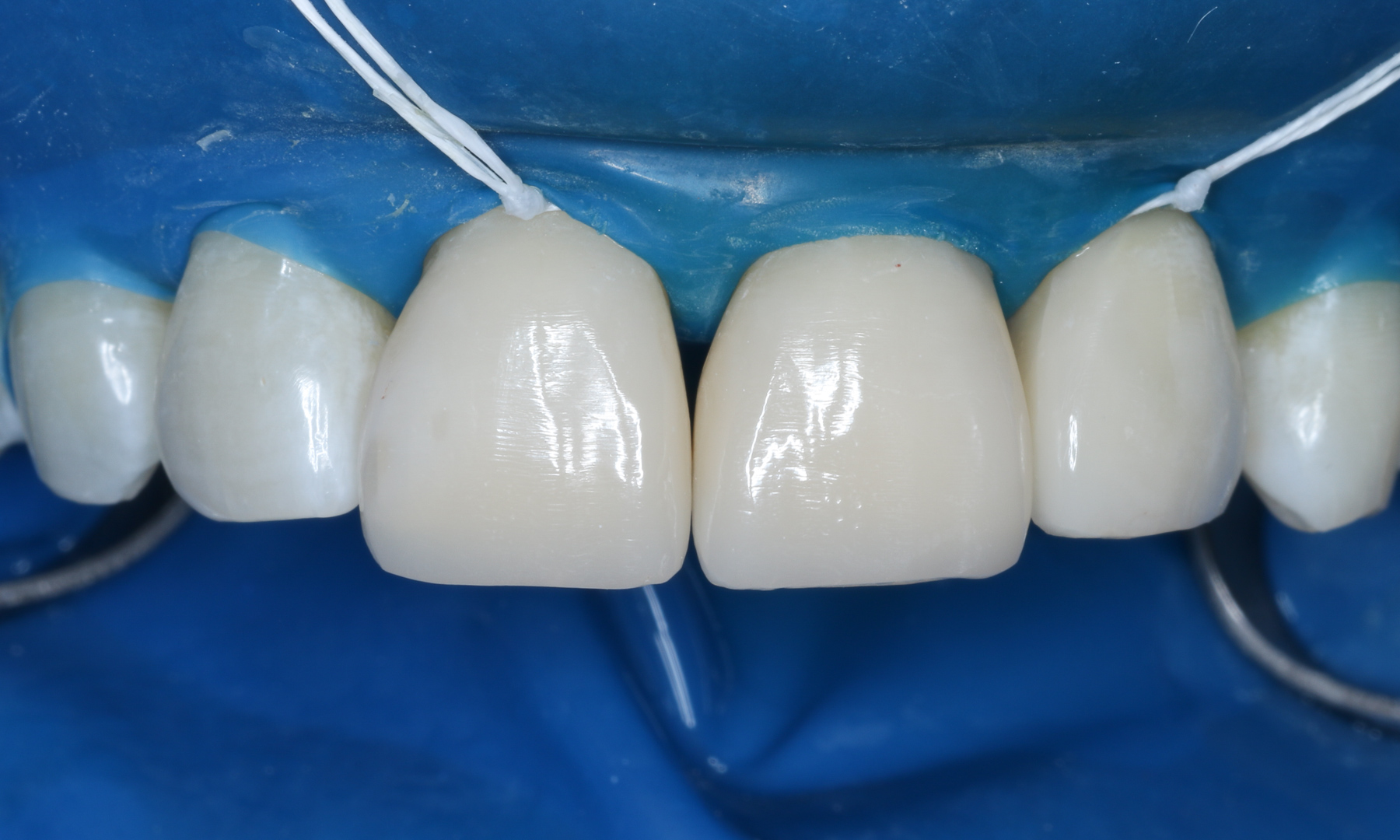 Frontalansicht der Zähne Frontalansicht der Zähne