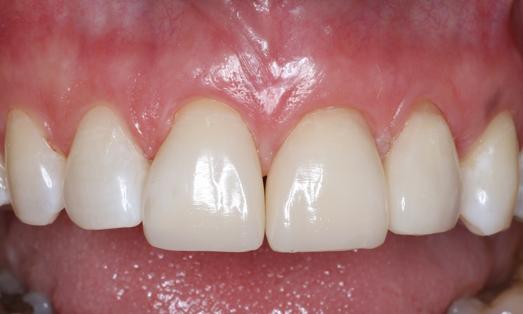 Ergebnis unmittelbar nach Zahnbehandlungsabschluss Ergebnis unmittelbar nach Zahnbehandlungsabschluss