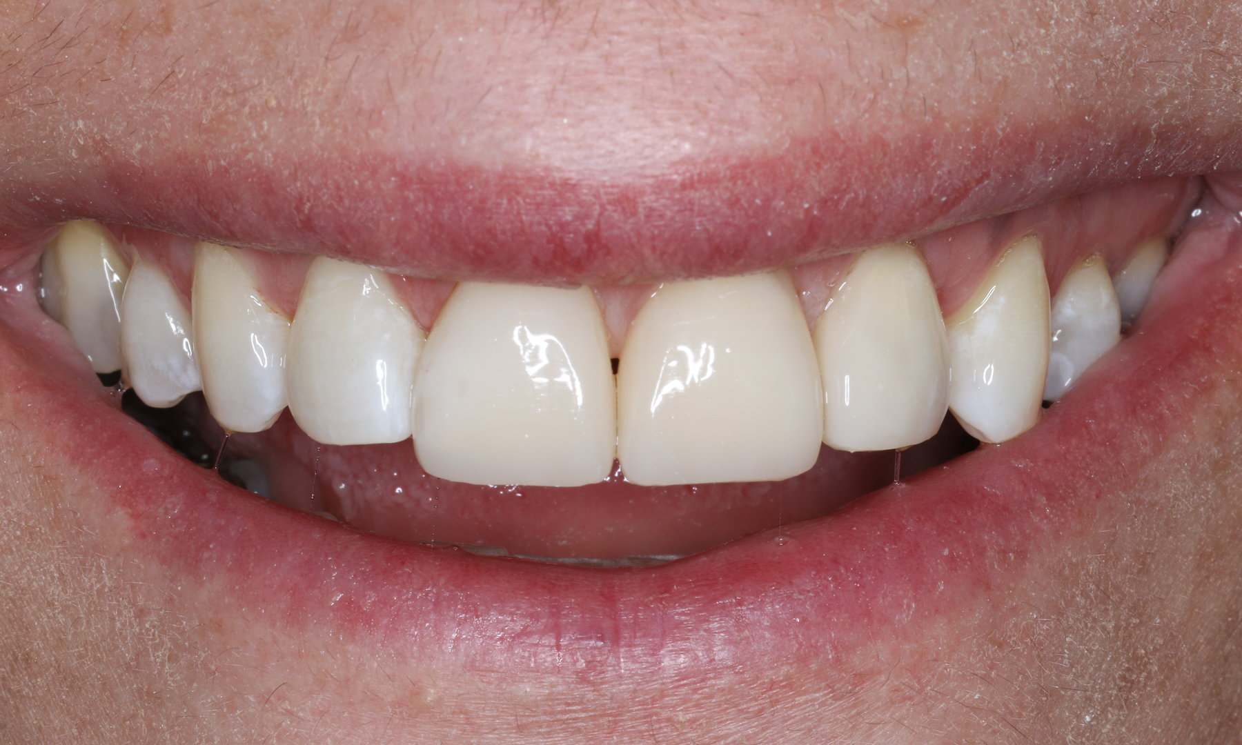 Lächeln der Patientin unmittelbar nach der Behandlung Lächeln der Patientin unmittelbar nach der Behandlung