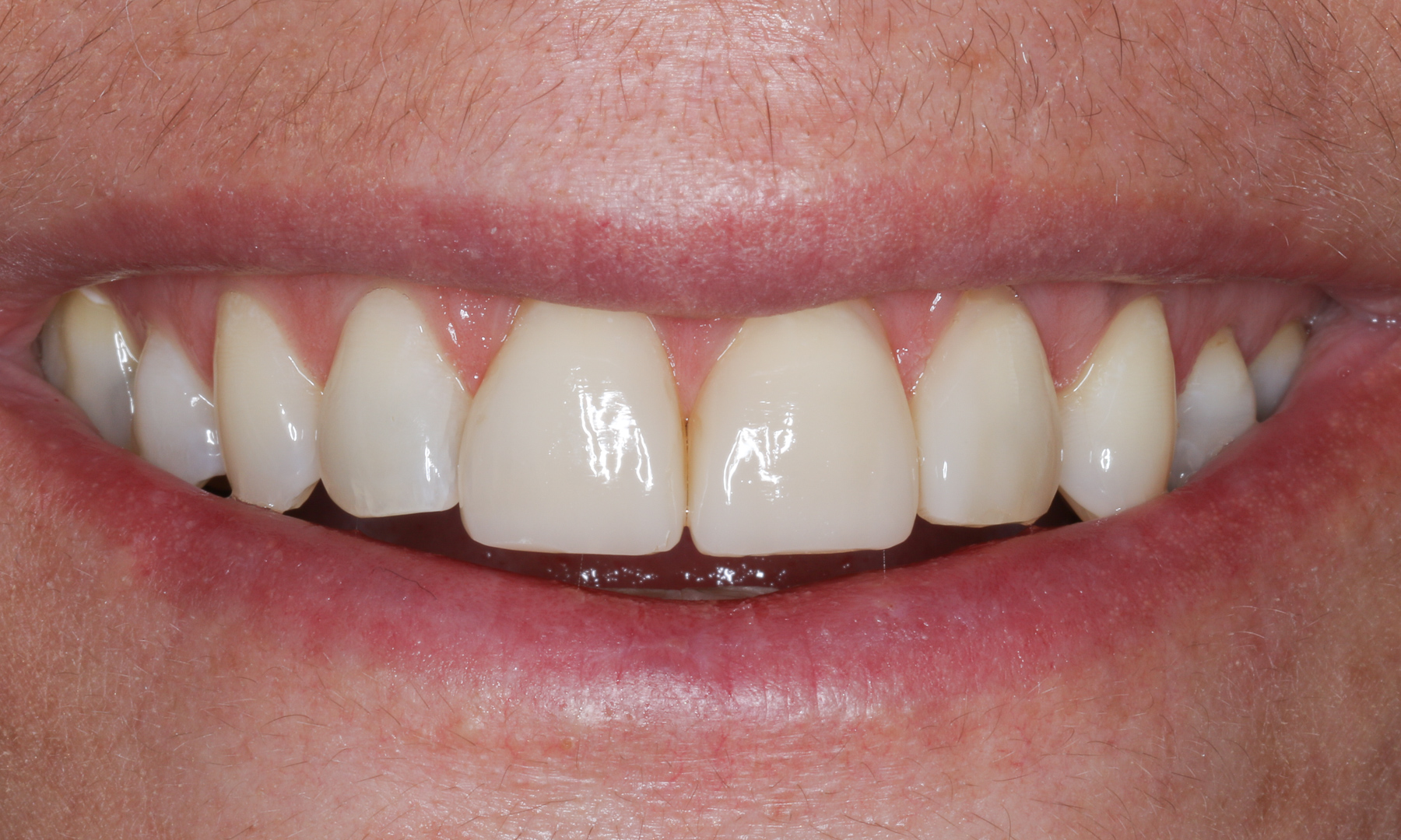 Lächeln der Patientin nach vier Wochen Lächeln der Patientin nach vier Wochen