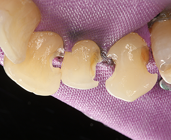 Ansicht der präparierten Zähne von lingual