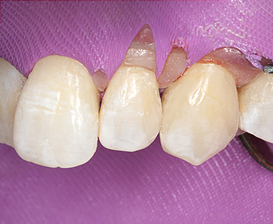 Ergebnis gleich nach der Zahnbehandlung