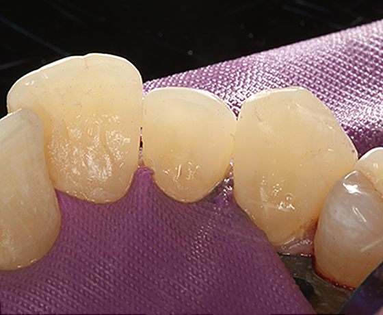 Selbst im Durchlicht schwer erkennbarer Übergang bei den Zähnen