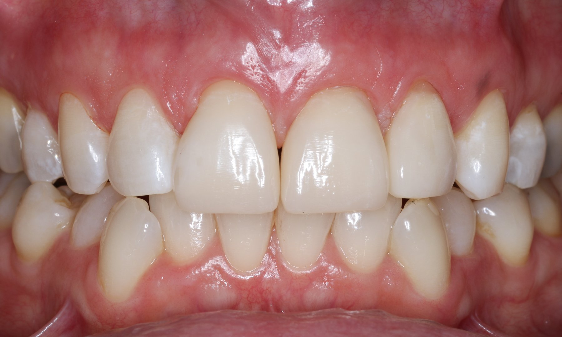 Postoperative Aufnahme der Zähne in Okklusion Postoperative Aufnahme der Zähne in Okklusion