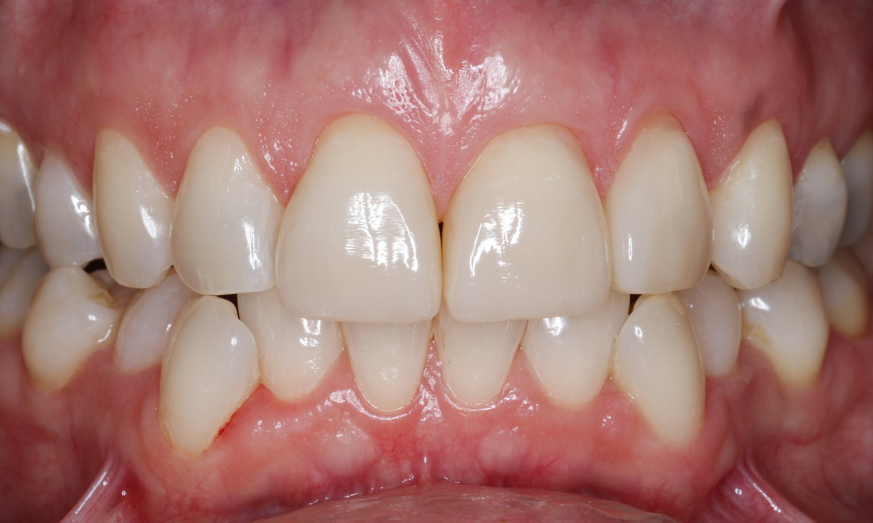 Zähne in Okklusion nach vier Wochen Zähne in Okklusion nach vier Wochen