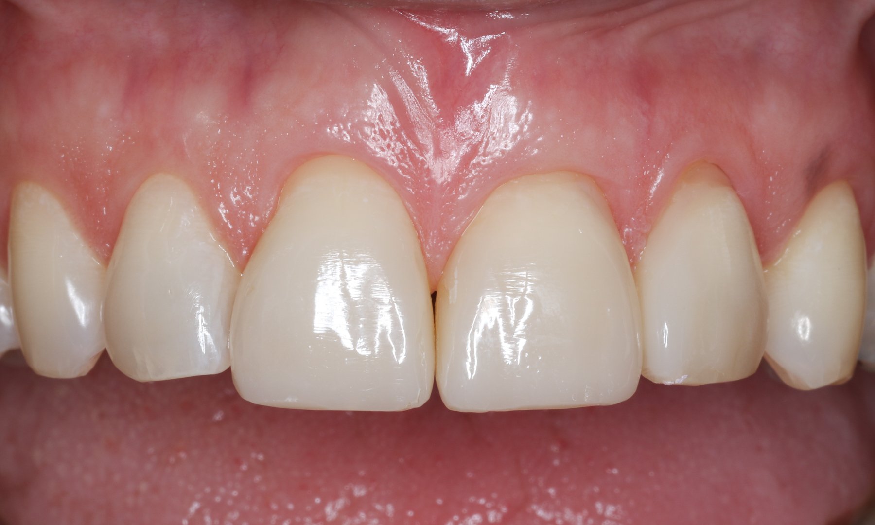 Ergebnis der Zähne nach vier Wochen Ergebnis der Zähne nach vier Wochen