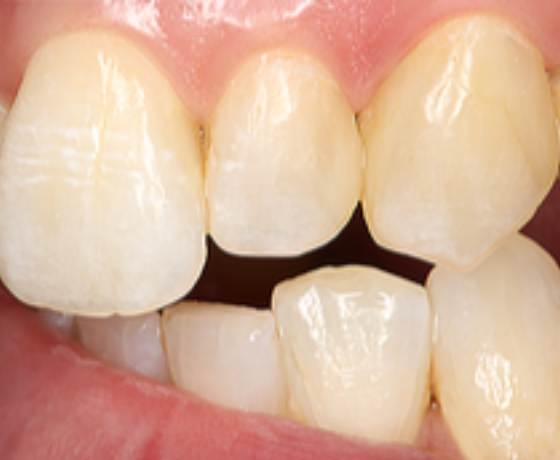 Behandlungsergebnis der Zähne nach drei Wochen