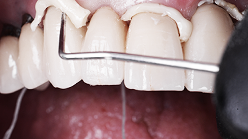 Entfernung von überschüssigem 3M™ RelyX™ Universal Befestigungskomposit